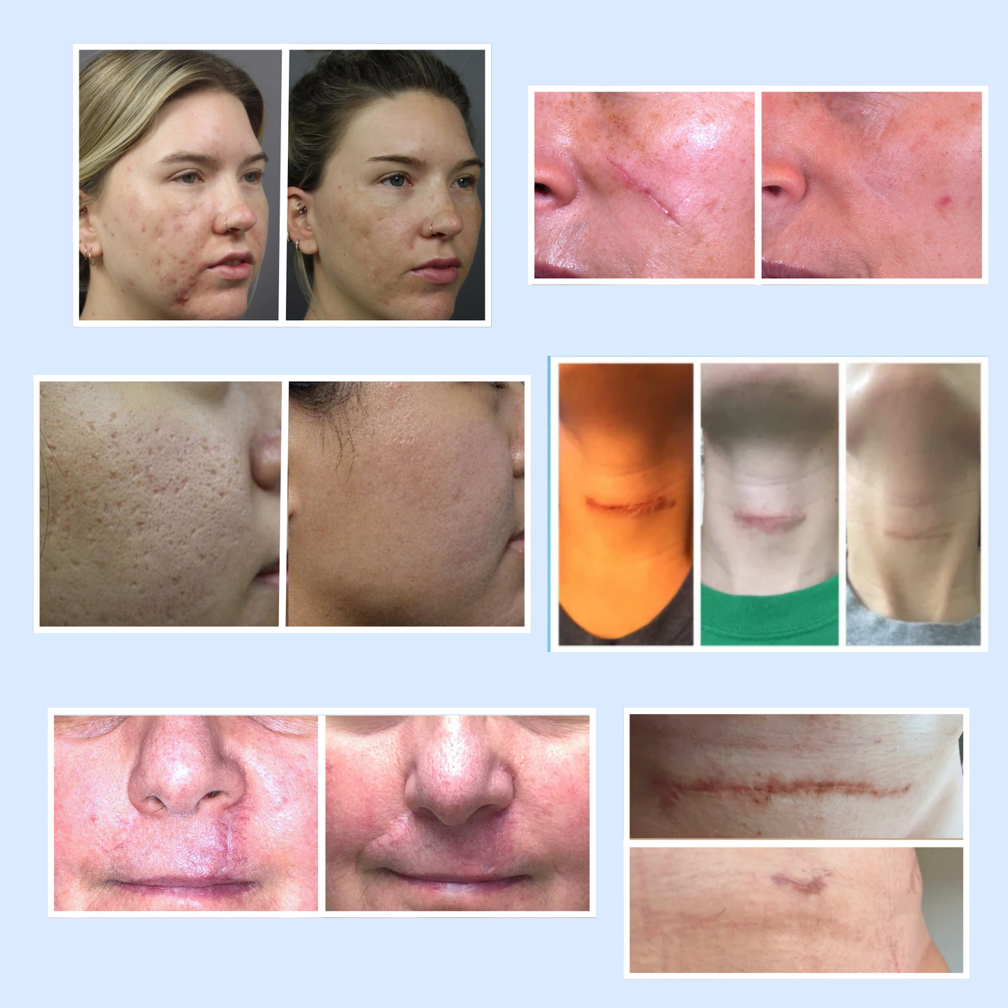 Premium Scars&Wrinkles Tape